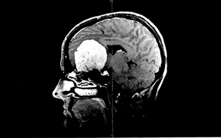 CT scan of Sharyl Garza April 2014 (date of diagnosis)